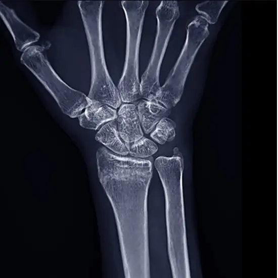 X-ray Right Wrist AP/LAT